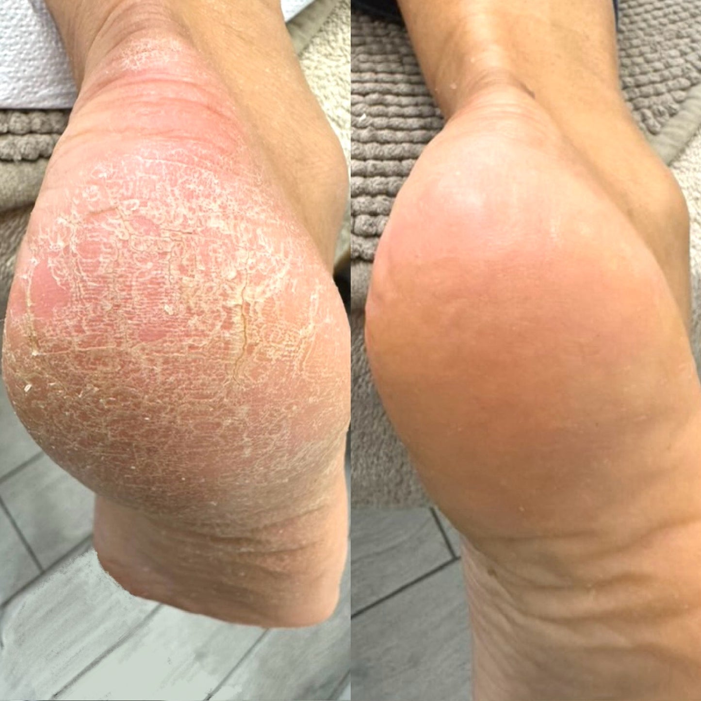 LOVASKIN INSTANT FOOT PEEL Essential Duo - Instant Foot Peel 75 ml with Instant Moisturizer 50 ml